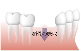 複数歯欠損（抜けている歯が2～3本の場合）