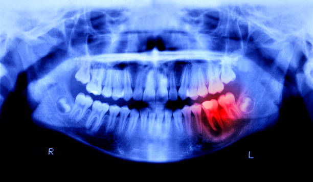 智歯周囲炎（歯周病）