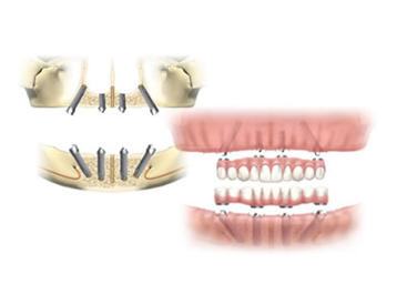 4本のインプラントで全ての歯を作ってしまうという、画期的な治療法です。